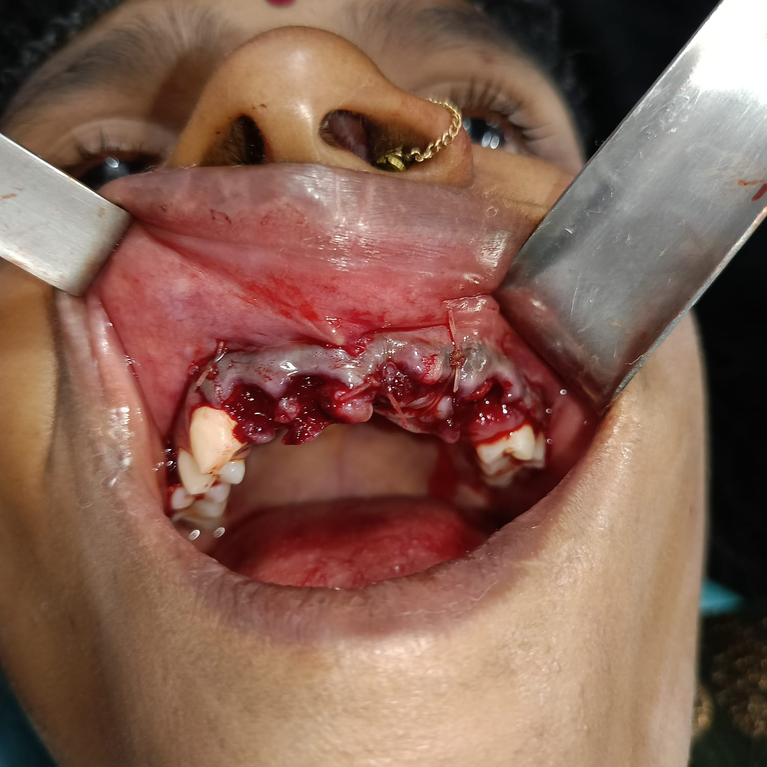 Surgical site after removal of multiple upper anterior teeth (Full Mouth Rehabilitation Case)